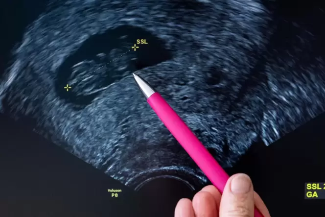Manchmal bleibt nicht mehr als ein Ultraschallbild. Statistiken zufolge erleidet etwa jede sechste schwangere Frau eine Fehlgebu